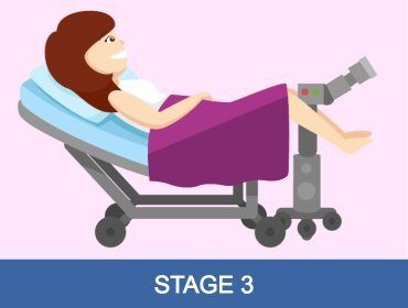 Donazione degli ovuli Stage 3